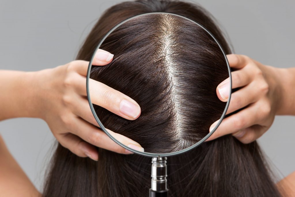 Enlarge,A,Woman's,Scalp,With,A,Magnifying,Glass.