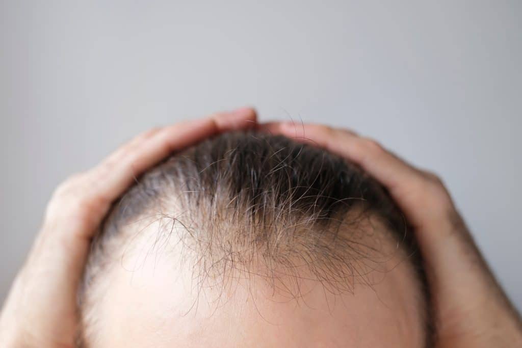 Patient suffering from hair thinning