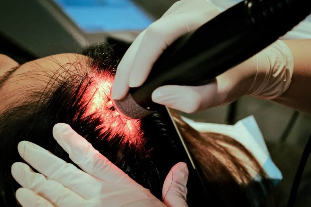 A Patient Undergoing Terra TrichoPAT, a non-invasive hair restoration treatment done in-clinic