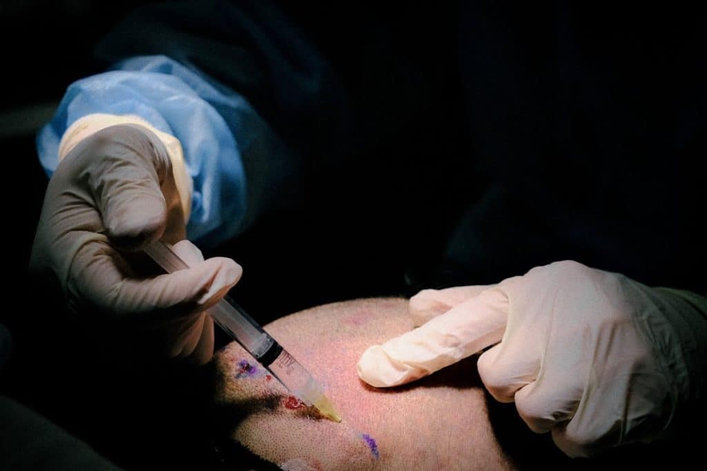 Doctor preparing the patient for a hair transplant surgery in singapore