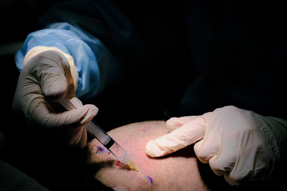 Doctor preparing the patient for a hair transplant surgery in singapore
