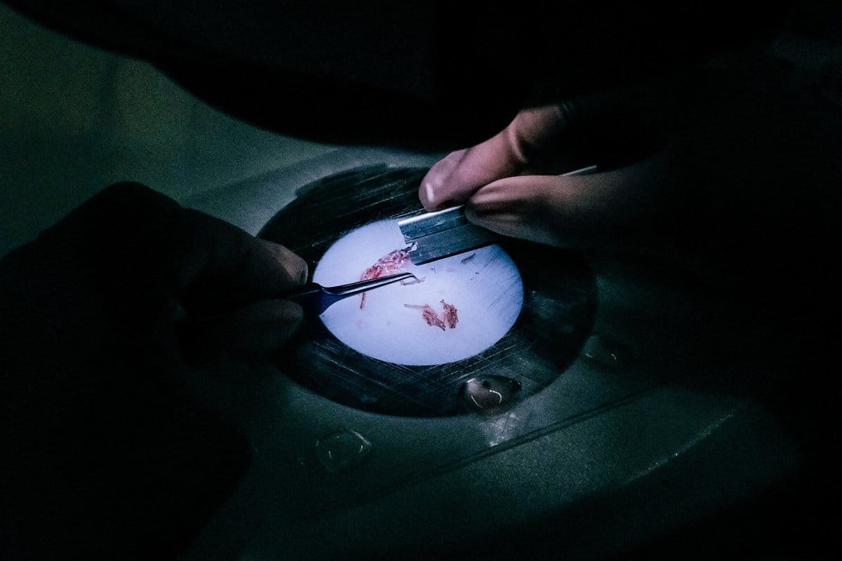 A hair technician segregating the grafts and readying them for implantation