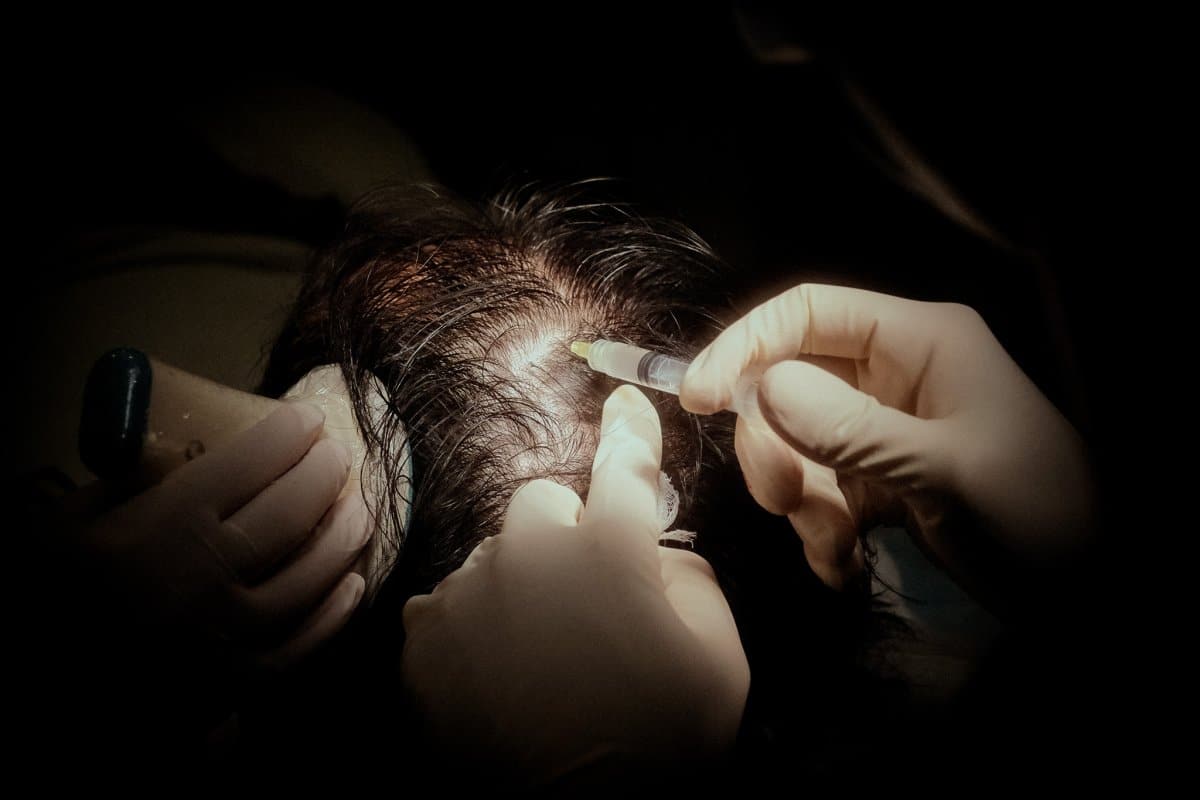 The doctor is performing Regenera AMT on a patient in Singapore. He's injecting the solution back into the areas of the scalp that are thinning.