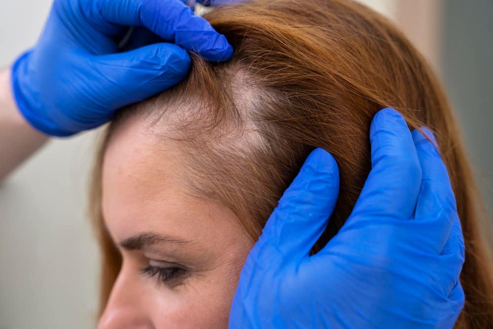 stress related hair loss