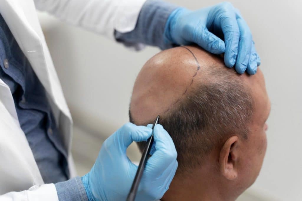 Searching for "Hair Transplant Near Me"? Why Clinical Expertise Trumps Proximity