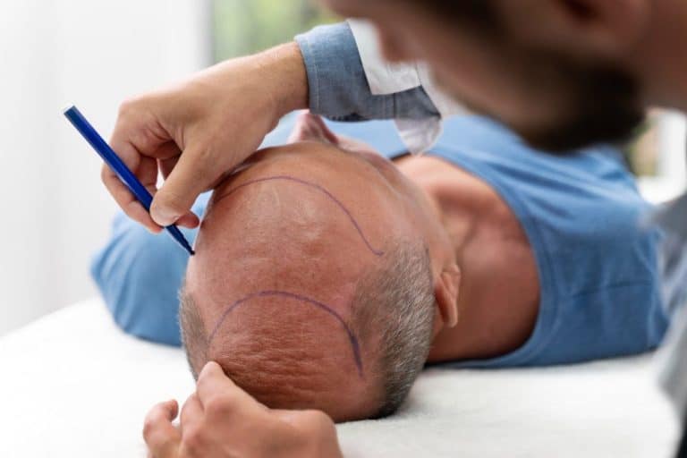 FUE vs FUT Hair Transplant: How the Two Methods Differ
