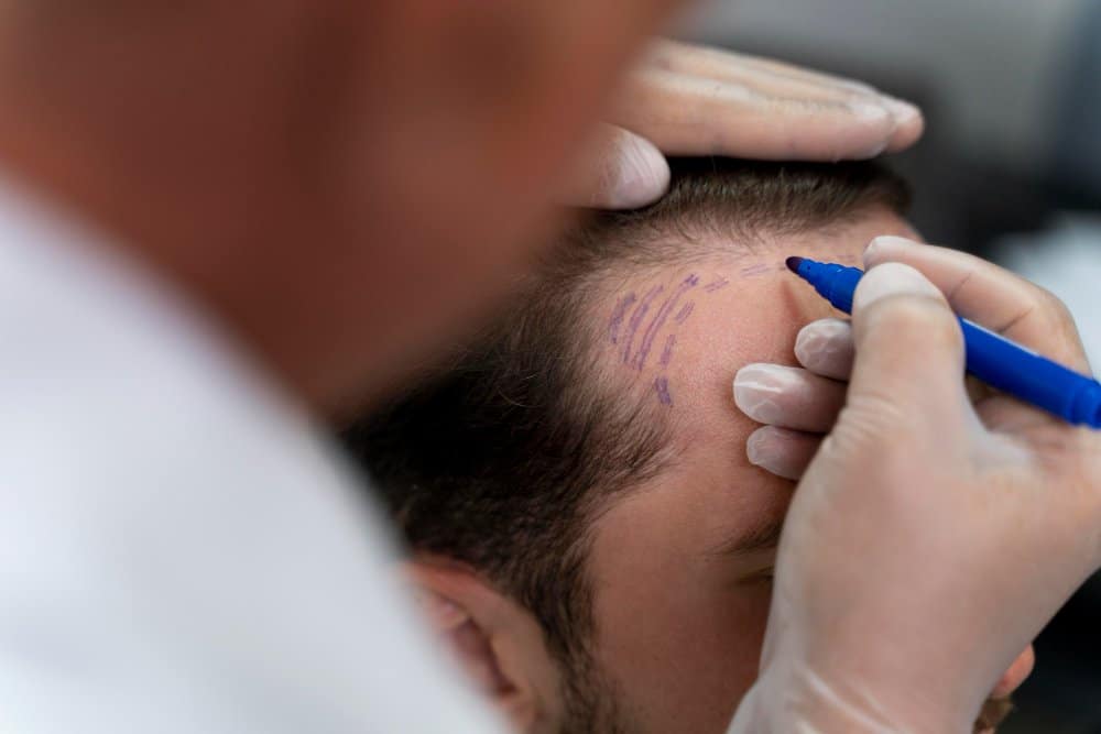 How Many Hair Grafts Do You Need?