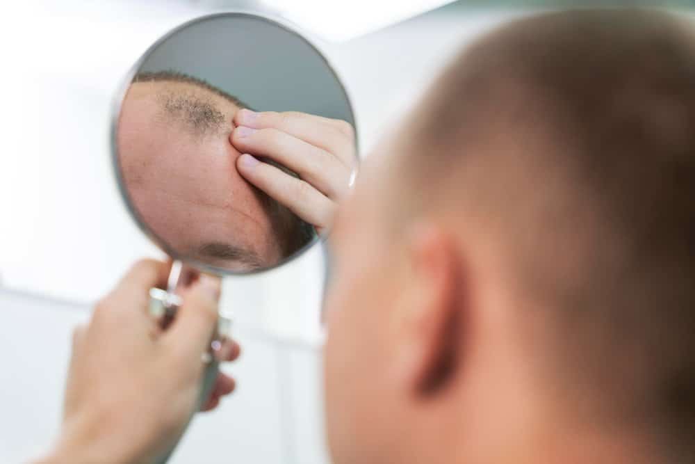 The Norwood Scale: Stages of Male Pattern Hair Loss